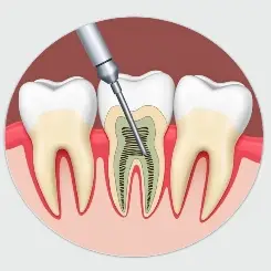 Root Canal Therapy